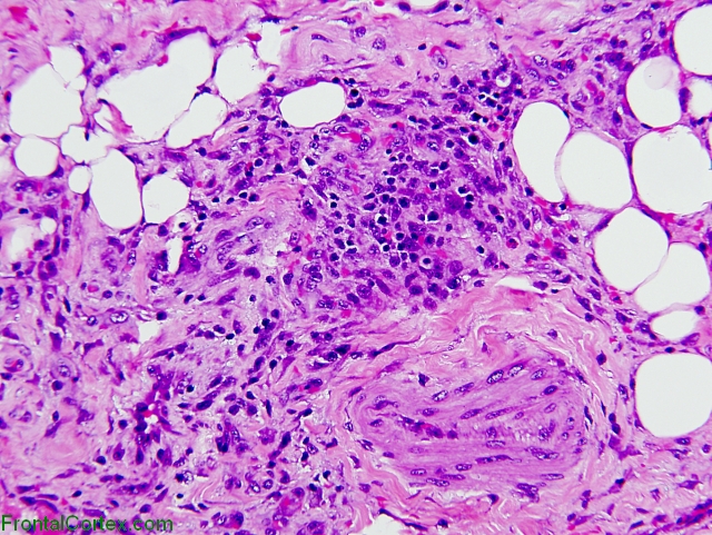 Perivascular infiltrate, H&E stained section of paraffin embedded skeletal muscle x200